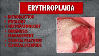 Erythroplakia  Erythroplakia Best Lecture Erythroplakia in depth [upl. by Kall]