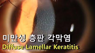 미만성 층판 각막염 Diffuse Lamellar Keratitis [upl. by Prue]