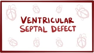 Ventricular septal defect VSD  repair causes symptoms amp pathology [upl. by Zilevi]