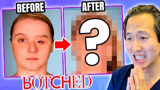 Plastic Surgeon Reacts to BOTCHED Incredible Eye Reconstruction [upl. by Terry655]