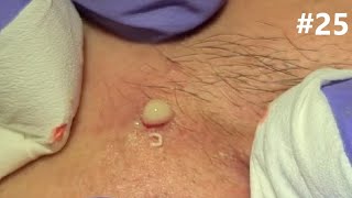 Blackheads Removal  Electrolysis on Happy 25 [upl. by Nulubez]