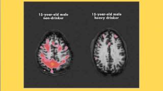 Alcohol and Addiction How it affects the Brain [upl. by Norved]