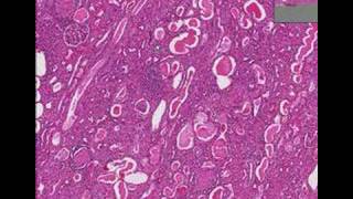 Histopathology KidneyChronic glomerulonephritis [upl. by Ronoel46]