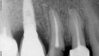 Endodoncia completa premolar superior [upl. by Melanie]