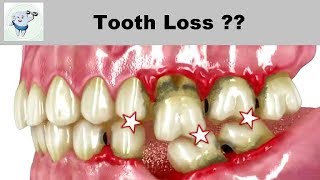 Consequences of Tooth Loss [upl. by Iren]