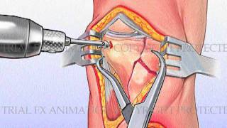 Tibial Plateau Fracture with Metal Plate Fixation [upl. by Aloysia]