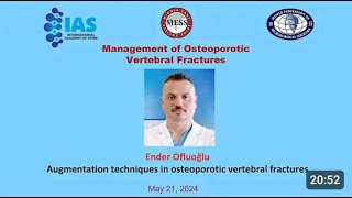 Management of Osteoporotic Vertebral Fractures quot Augmentation techniquesquot [upl. by Niltak]