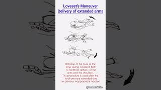 lovesets maneuver  viralshorts lovesetsmaneuver maneuver [upl. by Hubey]