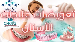 CNOPS CNSS حصريا طريقة حساب تعويضات علاجات الأسنان المعتمدة من طرف ✅ [upl. by Saitam335]