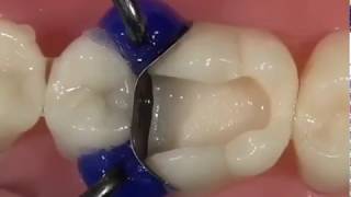 White Composite Filling a Molar  Rajan Dental [upl. by Iman322]