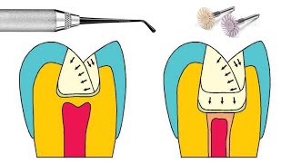 Manipulación de resina dental [upl. by Hillinck633]