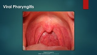 Viral Pharyngitis [upl. by Magbie]