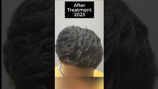 quotHair PRP Transformation at CARA  Before amp After Shotsquot prptreatment [upl. by Naed]