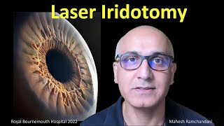 Laser Iridotomy the works Mahesh Ramchandani explores all about laser for angle closure glaucoma [upl. by Herv710]