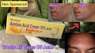 Aziderm 10 Cream Review  Azelaic Acid Cream Review [upl. by Etteneg]