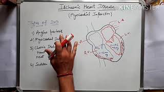 Ischaemic heart disease  Myocardial infarction in hindi Part1 [upl. by Ahsienar]