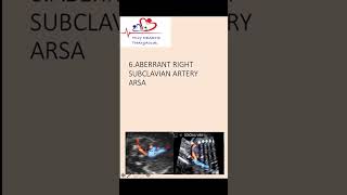 Aberrant right subclavian artery on antenatal scan softmarkers antenatalscan [upl. by Delilah]