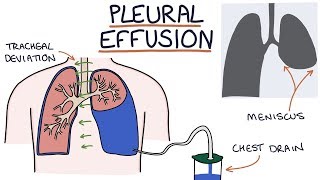 Understanding Pleural Effusions [upl. by Ennoirb627]