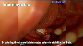 What is the role of drain in treatment of odontogenic infection [upl. by Zachar478]