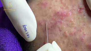 Loan Nguyen Acne Treatment 16122 [upl. by Abramson]