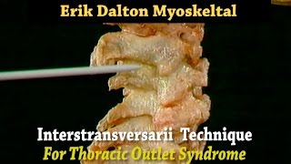 Myoskeletal Alignment Technique for Thoracic Outlet Syndrome [upl. by Euqinom]