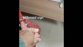 Milkmaid sign in patient with Huntington choreamedicine classroom [upl. by Ellehcar609]