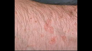 How to Removed Flat warts thru portable electric cautery underarm viral skincare warts trending [upl. by Nosiaj]