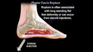 Plantar Fascia Rupture  Everything You Need To Know  Dr Nabil Ebraheim [upl. by Sivraj87]