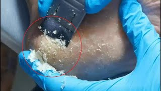 Long video here Remove dead skin slowly Cracked heel treatment amp Callus removal Dead skin removal [upl. by Llerahc]