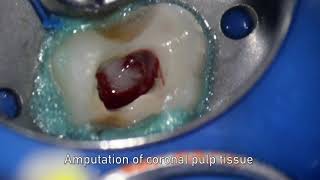 MTA pulpotomy – Video abstract ID 134315 [upl. by Waite78]