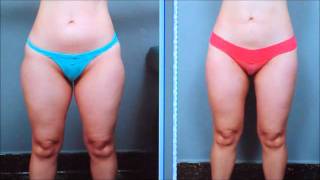 Slimmer Thighs With Liposuction  Dr Sterry Explains [upl. by Eugene]