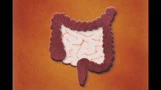 Patología Isquémica Intestinal Definición Evaluación Tratamiento [upl. by Nahtanha]