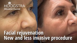 Facial rejuvenation  New and less invasive procedure  23257 [upl. by Rachele]