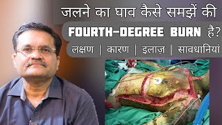 Classification of Burns  4th Degree Burn  4th डिग्री Burn का क्या इलाज़ [upl. by Tremayne562]