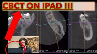 How to Open CBCT on the Ipad and Read any Radiographs and DICOM files cbct oralradiology [upl. by Blockus447]