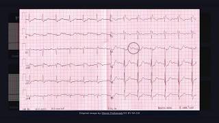 First Degree Atrioventricular Block ECG [upl. by Regnij]