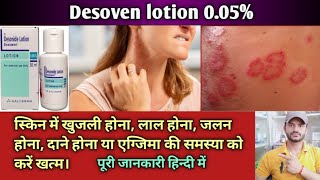 Desowen lotion use dose benefits and Side effects full review in hindi [upl. by Beryl]