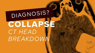 CT head breakdown a guide to subarachnoid haemorrhage [upl. by Stila]