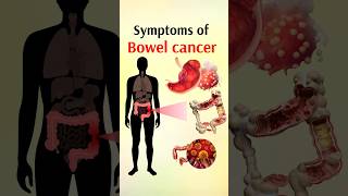 symptoms of bowel cancer shorts [upl. by Olds]