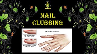 Nail clubbing  clubbed fingers  schamroths sign  lovibonds angle Grades of clubbing [upl. by Mckale520]