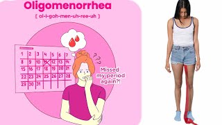 oligomenorrhea  oligomenorrhea causes [upl. by Llehsem]