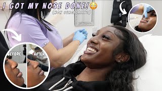 Guys I got a nose jobwith filler [upl. by Adas]