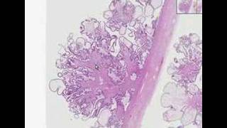 Histopathology OvarySerous cystadenoma [upl. by Christie784]