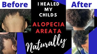 HOW I HEALED MY DAUGHTERS ALOPECIA AREATA NATURALLY🤯 CURE ALOPECIA‼️ HAIR REGROWTH TREATMENT 2024 [upl. by Ringler]