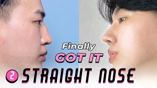 SUB Male Rhinoplasty Vlog in Korea  Nose Job with Hump Removal amp Fixing Deviation  BEFOREampAFTER [upl. by Divadnoj]