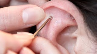 CHINESE AURICULAR ACUPUNCTURE 01 Principles [upl. by Enomrej133]