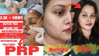 prp microneedling treatment kia hota haiPRP micro needling kese hota haifull explained in urdu [upl. by Ettenan243]