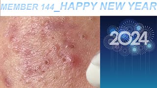 Acne Treatment Huong Da Nang 144  Member Happy New Year [upl. by Forrest496]