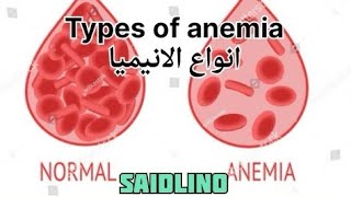 انواع الأنيميا شرح للطاقم الطبي Types of anemia [upl. by Raymund]