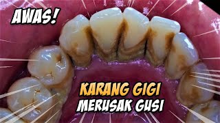 Deep Cleaning With HEAVY Tartar Build Up At The Dentist [upl. by Kleper]